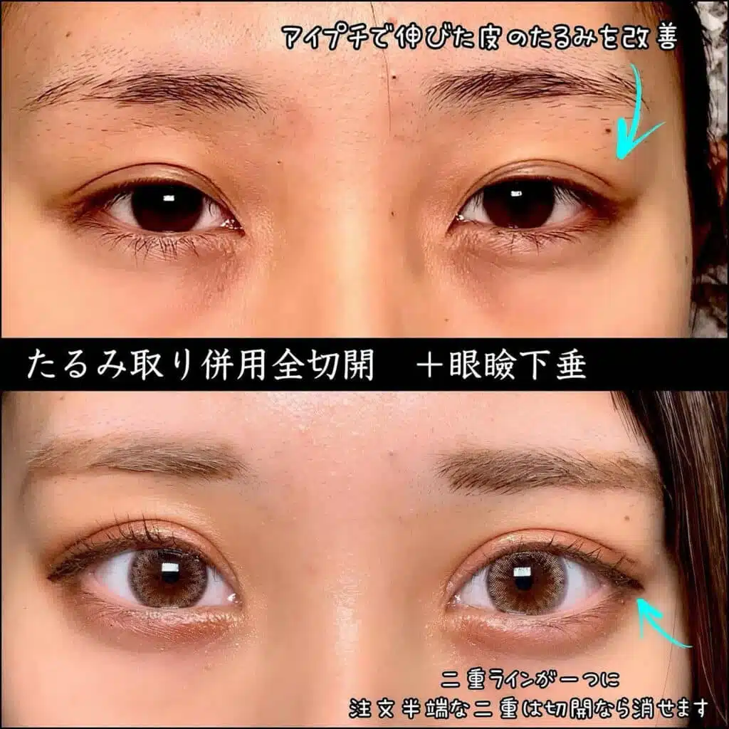 たるみ取り併用全切開+眼瞼下垂　大阪梅田