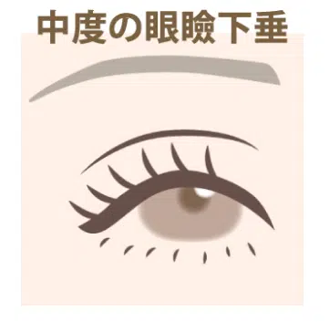 中度の眼瞼下垂　大阪梅田