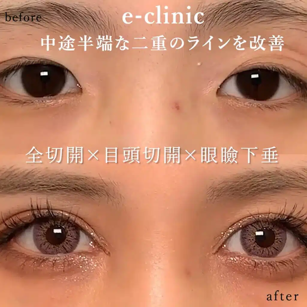 全切開×目頭切開×眼瞼下垂　大阪梅田