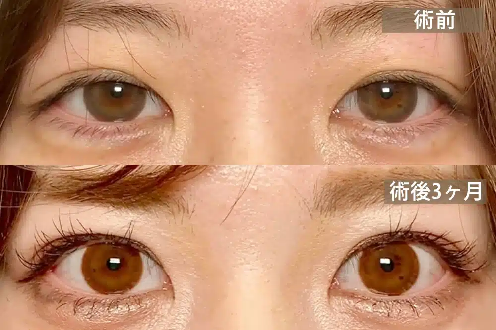 先天性眼瞼下垂　大阪梅田