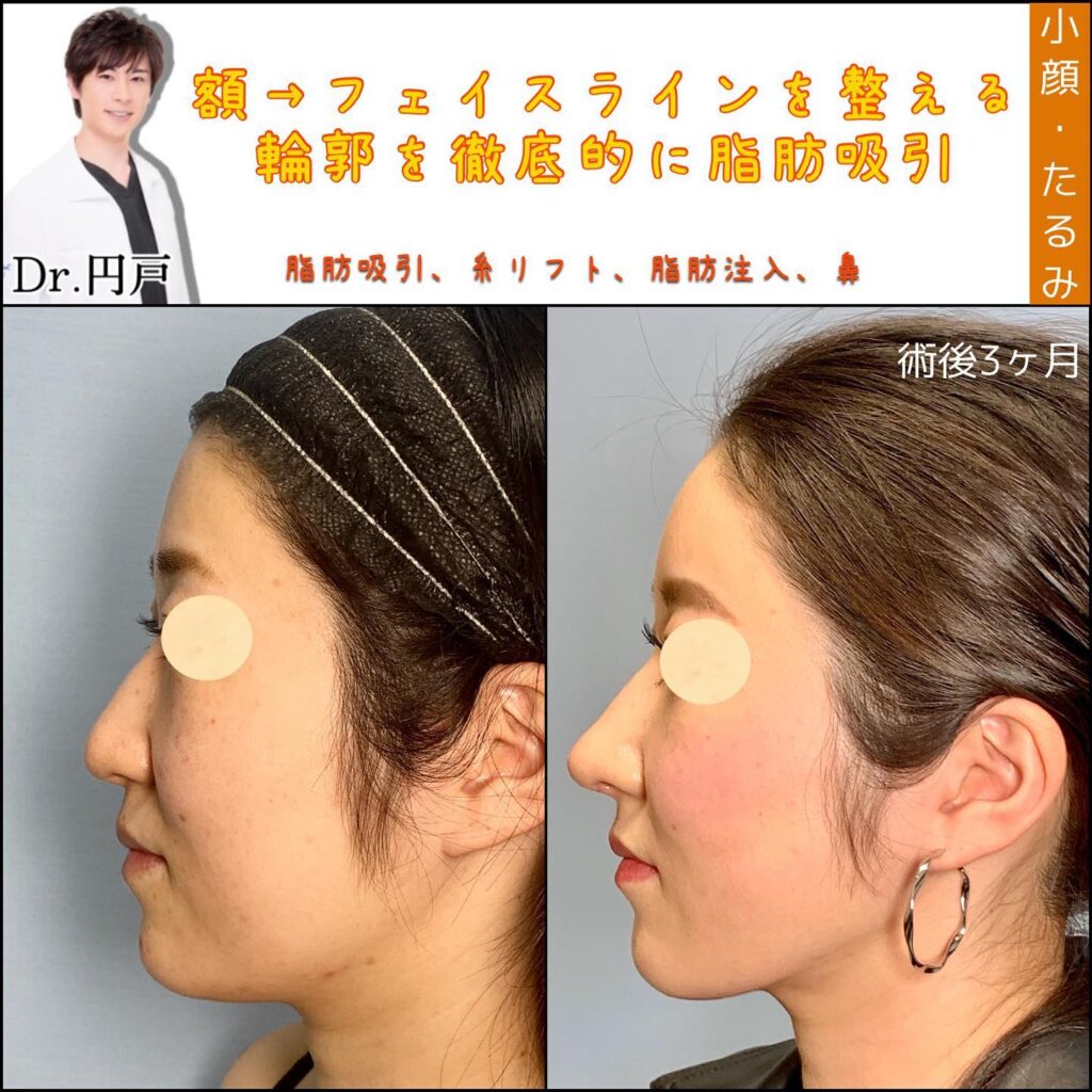 脂肪注入と糸リフトと小顔脂肪吸引の症例写真