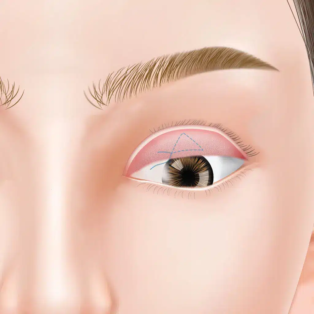 眼瞼下垂　手術方法　大阪梅田