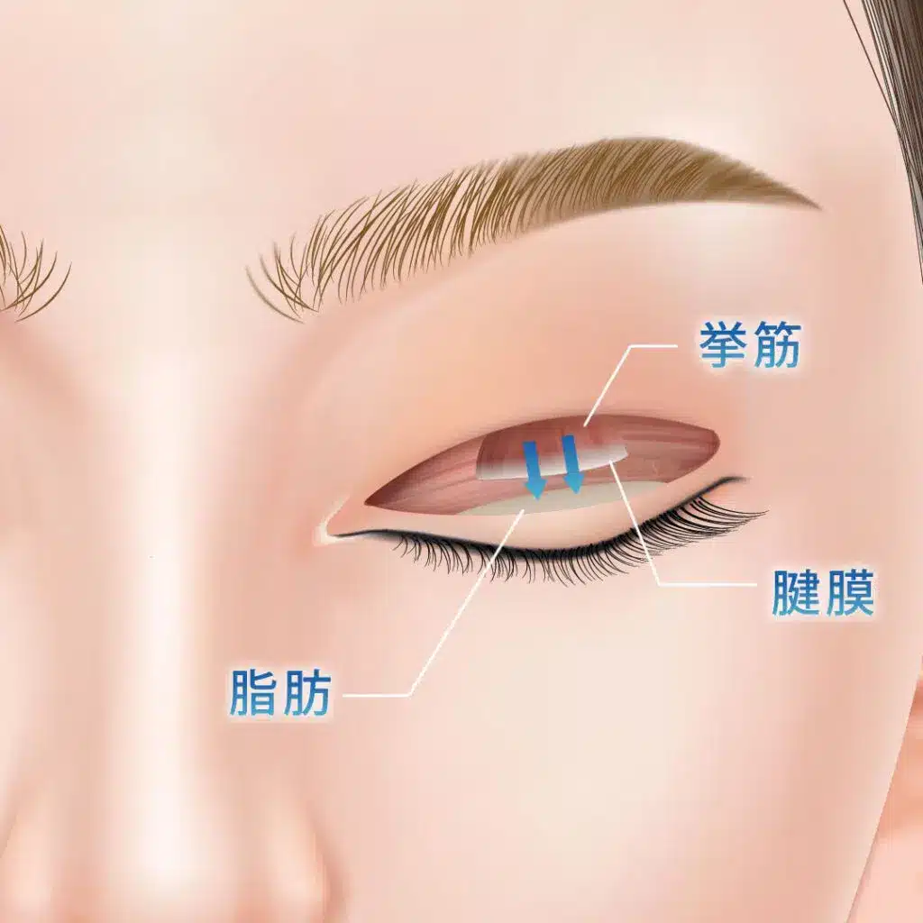 眼瞼下垂　手術方法　大阪梅田