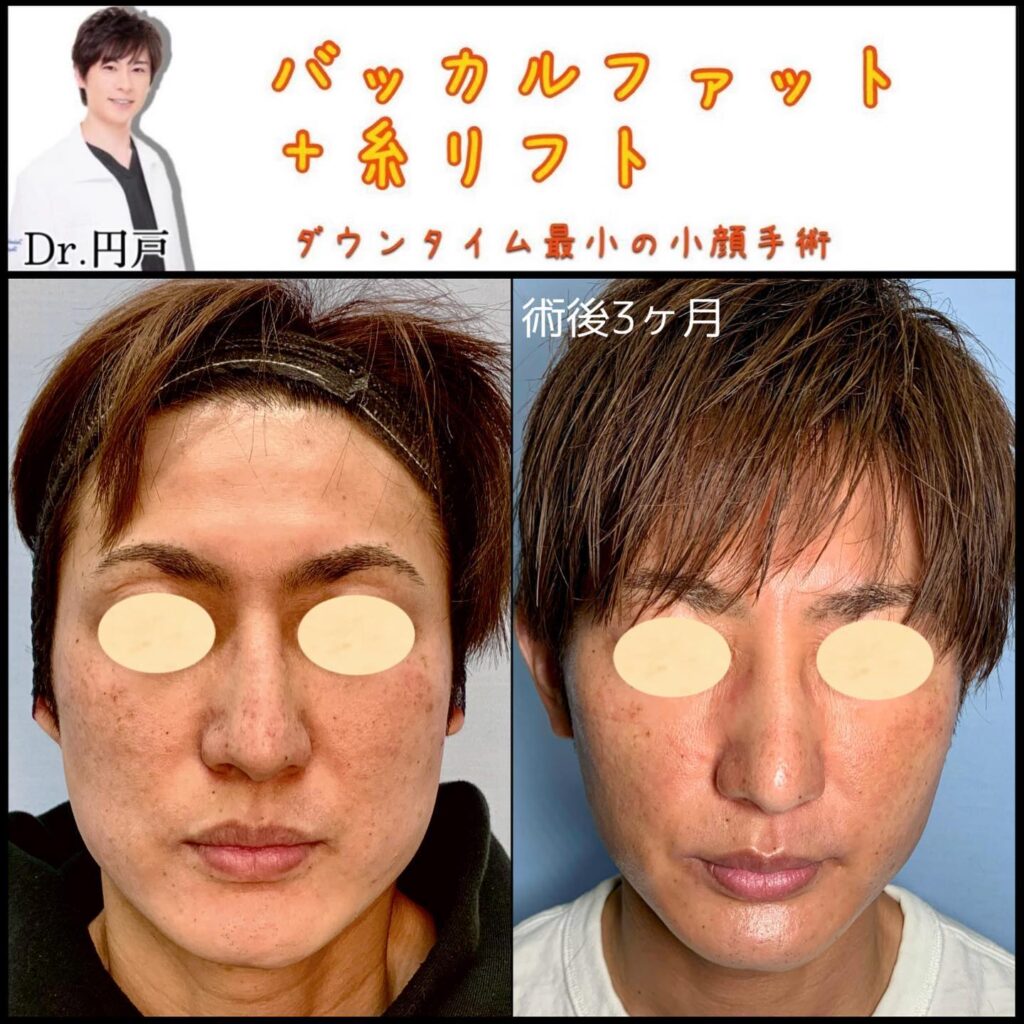 バッカルファットと糸リフトの症例写真