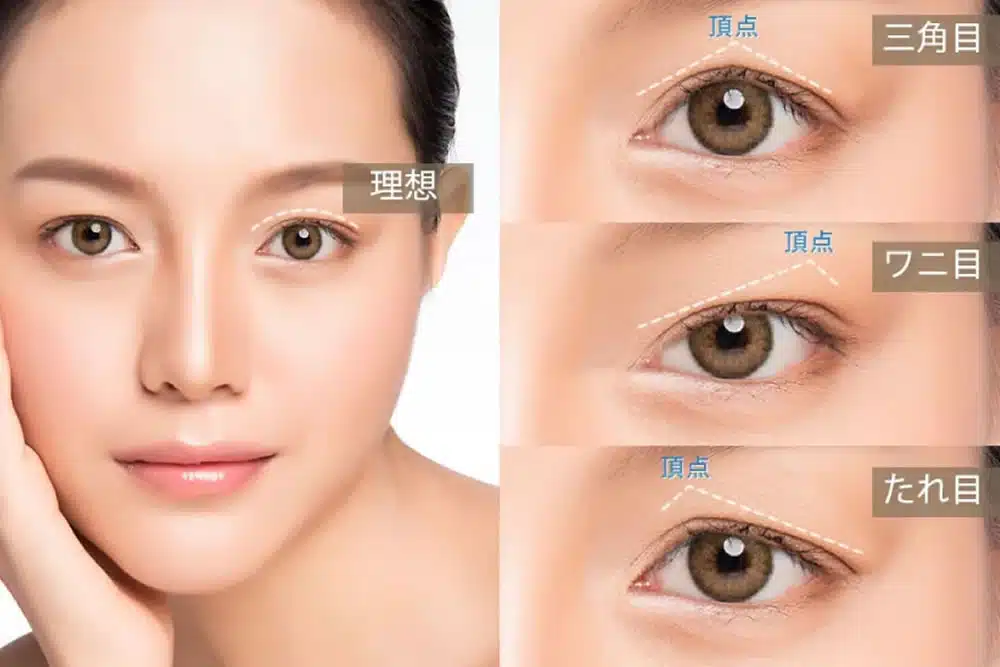 眼瞼下垂の失敗例の説明　大阪梅田