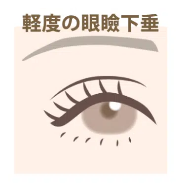 軽度の眼瞼下垂　大阪梅田