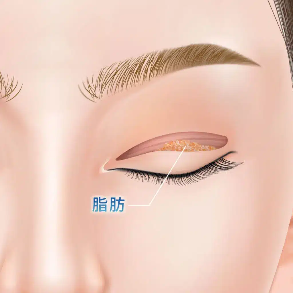 眼瞼下垂　手術方法　大阪梅田