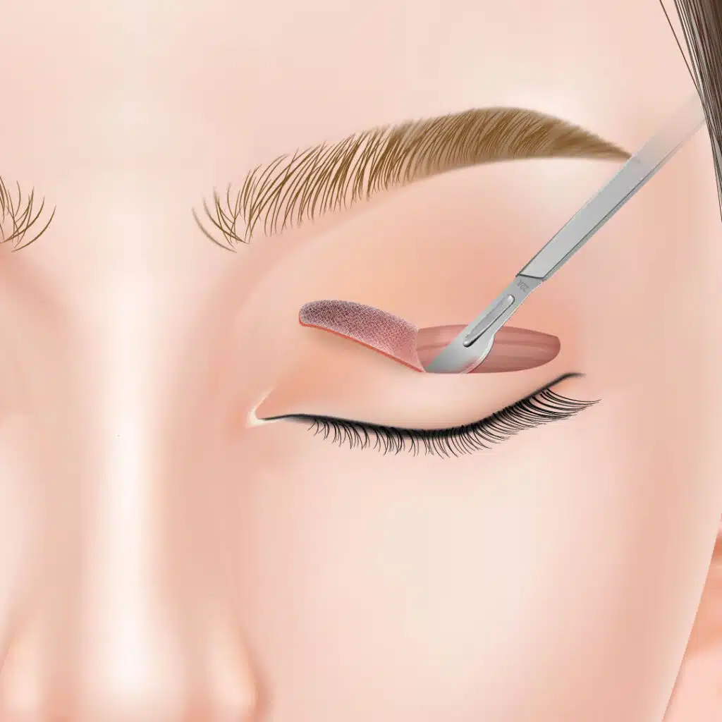 眼瞼下垂　手術方法　大阪梅田