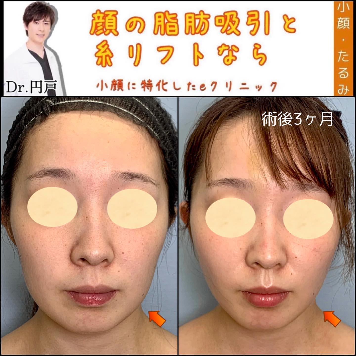 顔の脂肪吸引と糸リフトの症例写真 (6)