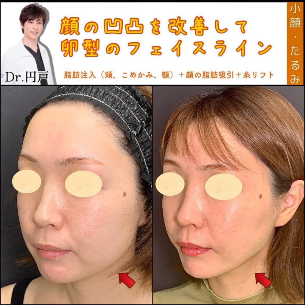脂肪注入と小顔脂肪吸引と糸リフトの症例写真