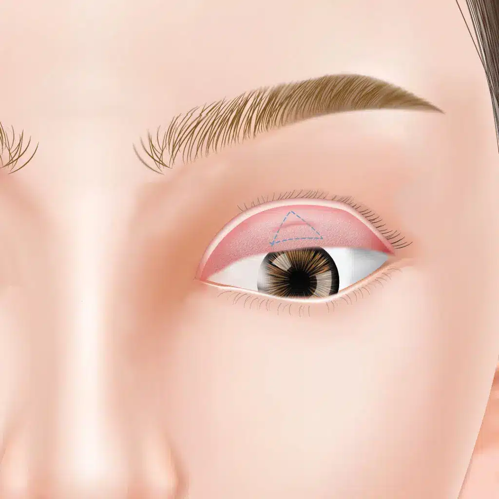 眼瞼下垂　手術方法　大阪梅田