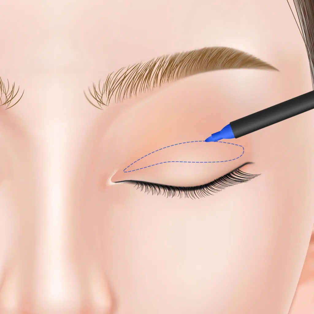 眼瞼下垂　手術方法　大阪梅田