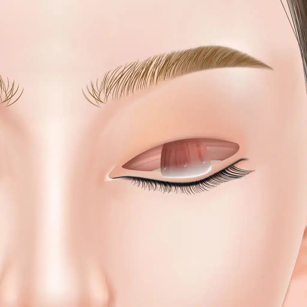 眼瞼下垂　手術方法　大阪梅田