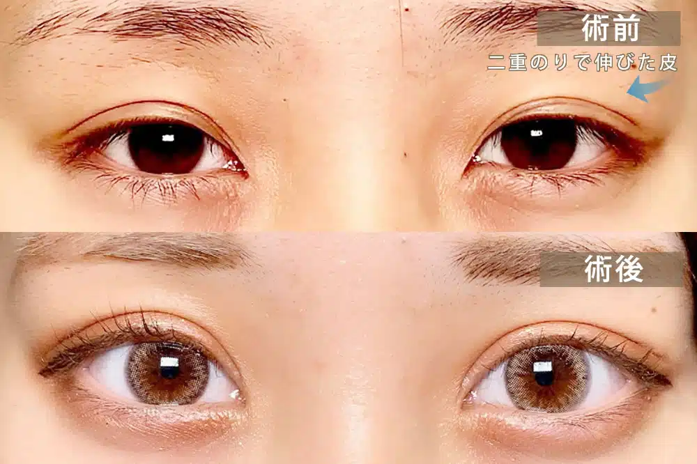 偽眼瞼下垂　大阪梅田