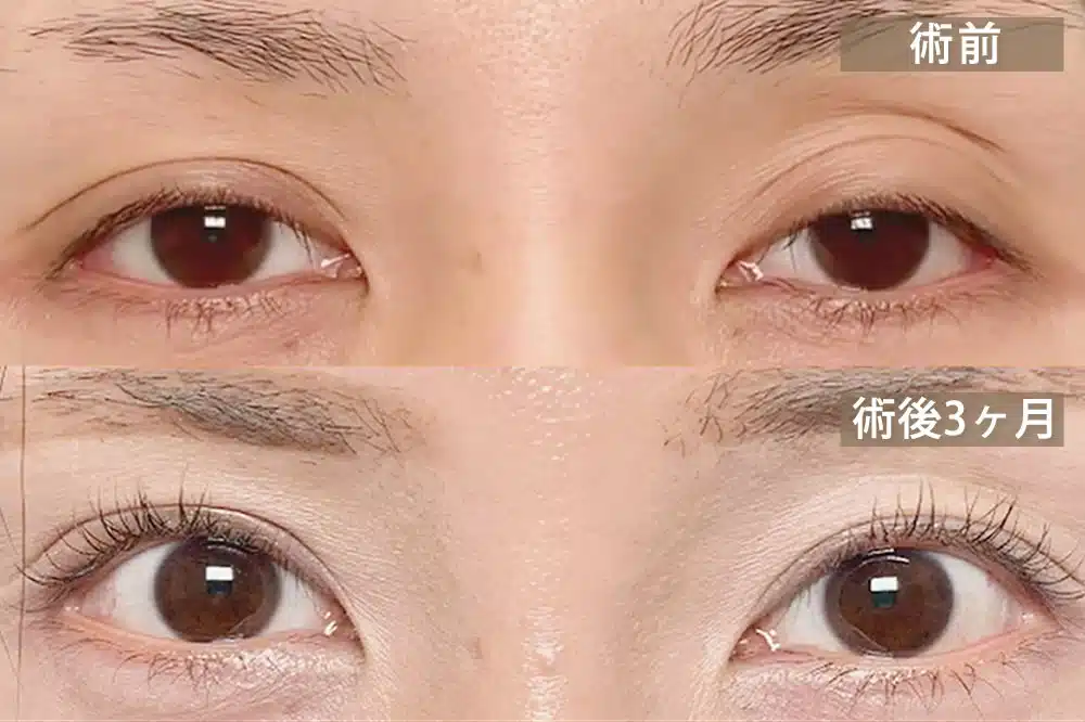 腱膜性眼瞼下垂（後天性眼瞼下垂）　大阪梅田