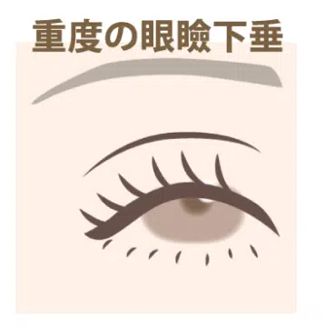 重度の眼瞼下垂　大阪梅田
