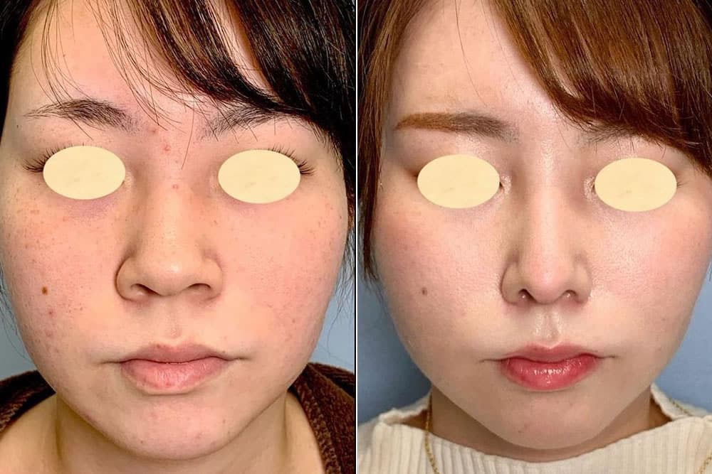 小鼻縮小の症例