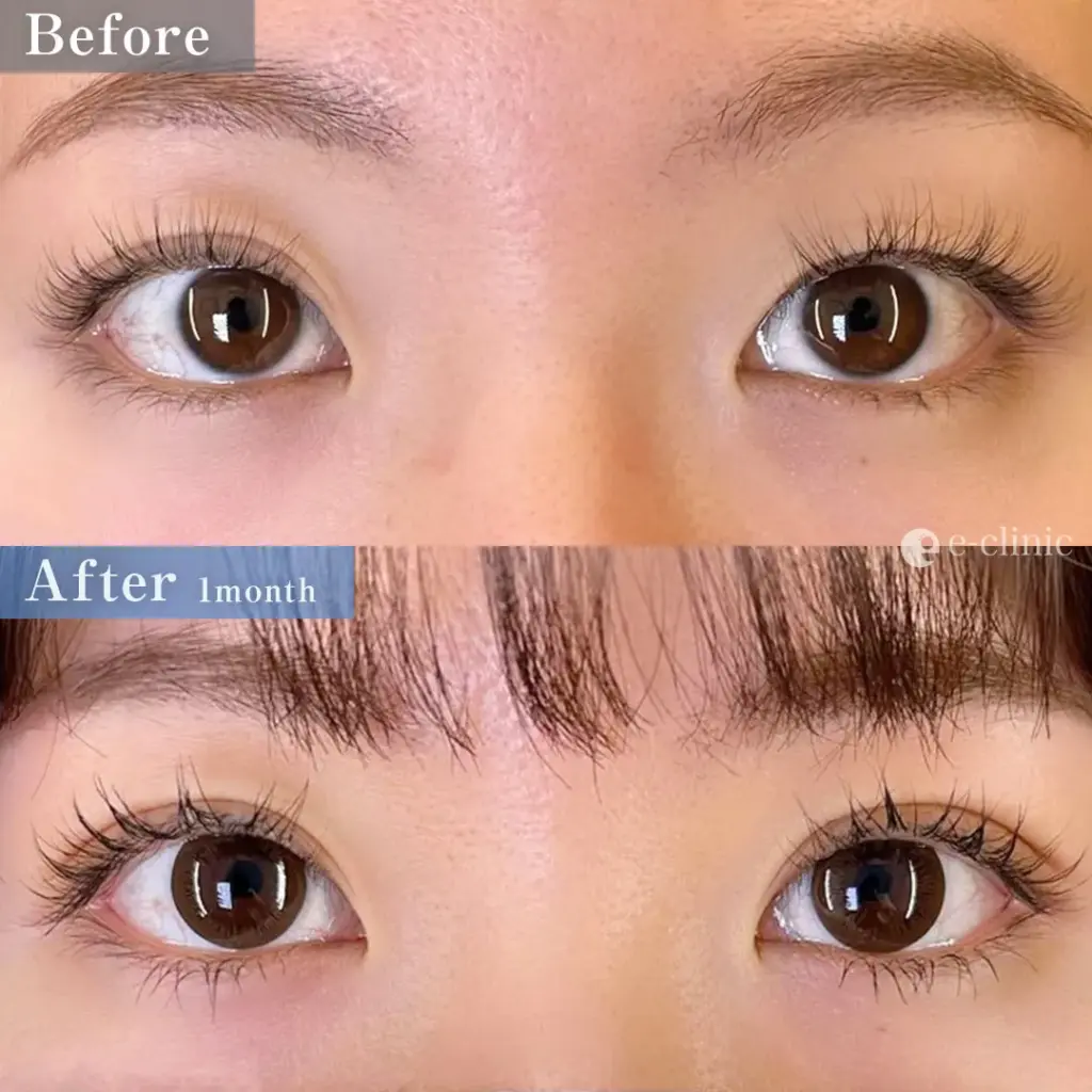 二重埋没法 クイックループダブル4点裏留めa