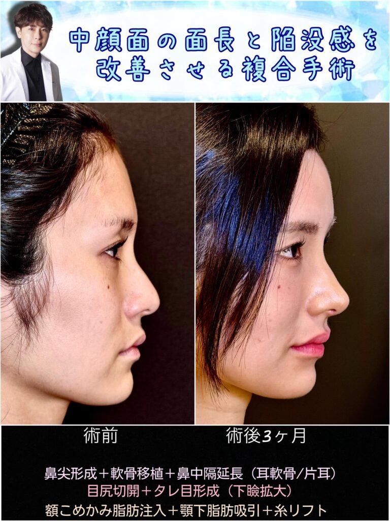 中顔面陥没を改善した横から見た症例写真 (1)