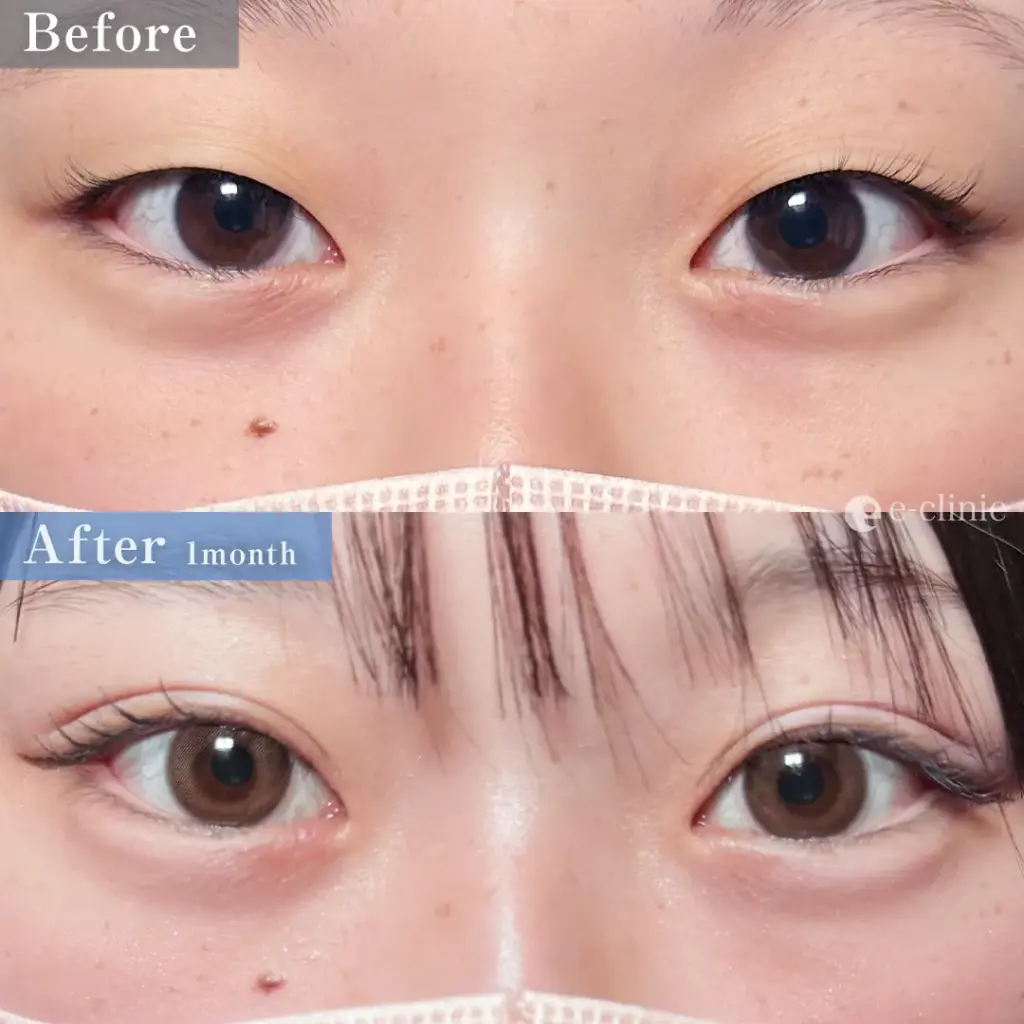 二重埋没法　自然癒着（伊藤）