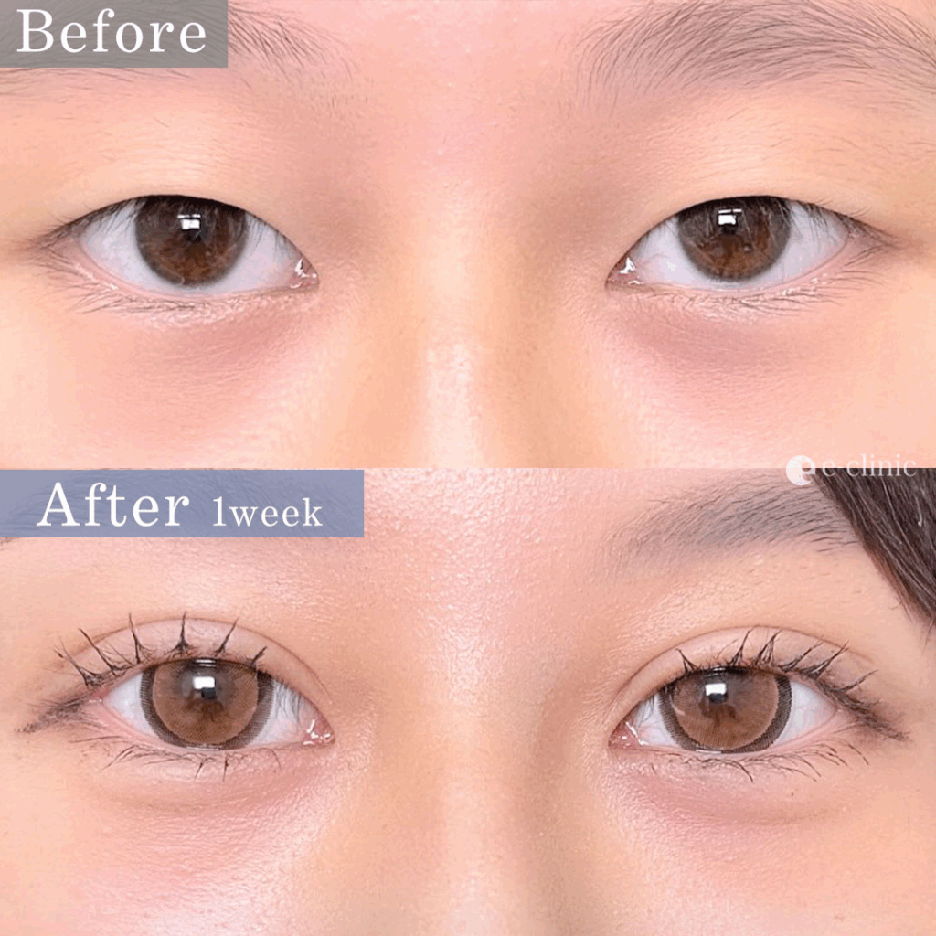 二重埋没 自然癒着法（相原）