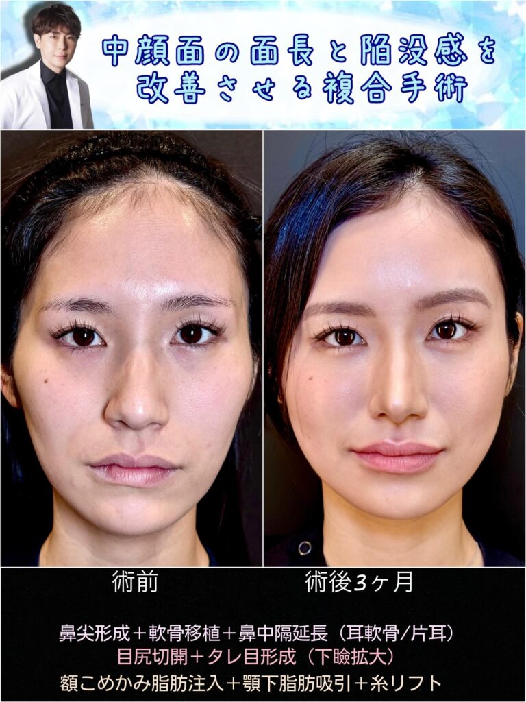 中顔面陥没を改善した正面から見た症例写真 (1)