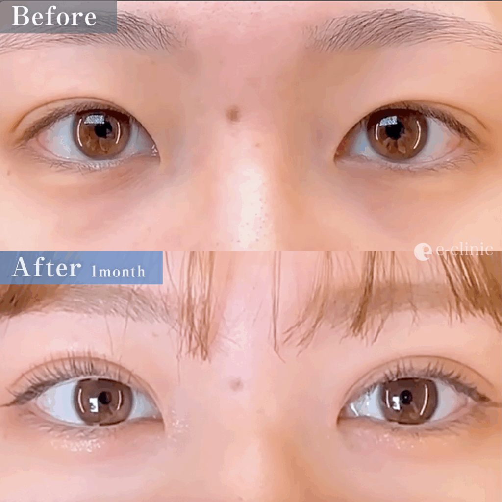 二重埋没法 クイックループダブル4点裏留め（島田）