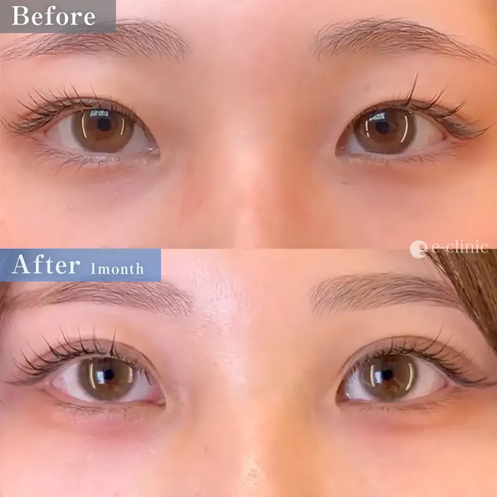 二重埋没法 クイックループダブル4点裏留め（島田）