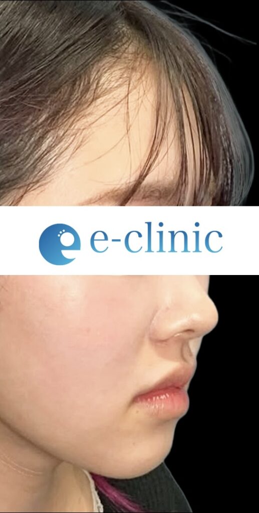 eクリニック大阪梅田院の脂肪注入＋脂肪吸引＋鼻フル＋目尻切開整形の症例術後3ヶ月写真
・目尻切開
・目尻靭帯再配置
・下眼瞼拡大・下制限（タレ目形成）皮膚＋結膜
・眉下切開
・鼻プロテーゼ
・鼻尖形成３D法
・鼻尖部軟骨移植または軟骨膜移植
・鼻中隔延長　保存軟骨
・超音波脂肪吸引Ultra-Z １部位（頬・顎下・メーラーファット）
・糸リフト
・脂肪注入 小パーツ（ゴルゴ）
・脂肪注入 大パーツ（額・こめかみ）
・鼻翼基部（法令線）人工真皮（貴族手術）
（名医の円戸望医師が執刀）