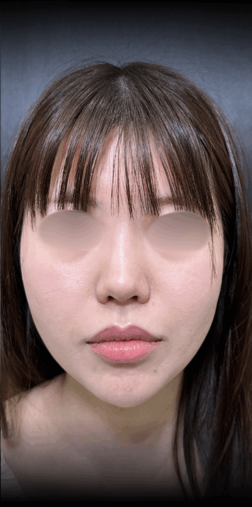 eクリニック大阪梅田院の糸リフトの症例術後写真（名医の脇谷雄一朗医師が執刀）