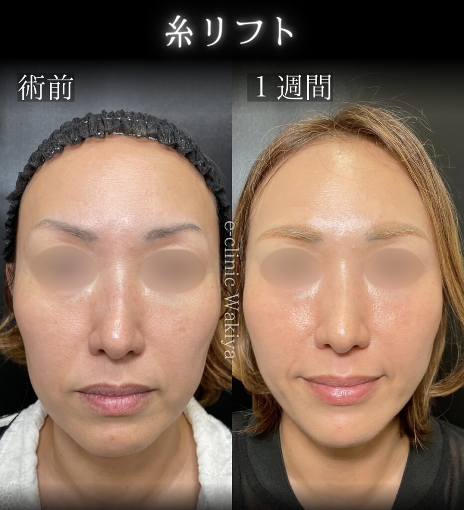 eクリニック大阪梅田院の糸リフトの症例写真（名医の脇谷雄一朗医師が執刀）