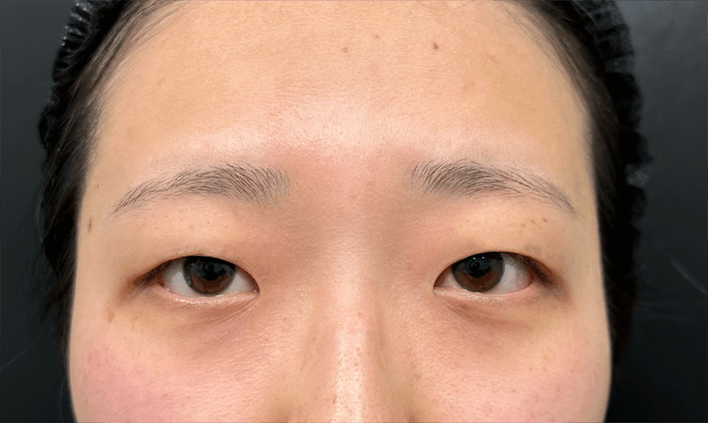 eクリニック大阪梅田院の二重埋没（二重整形）＋目頭切開の症例術前写真（名医の脇谷雄一朗医師が執刀）