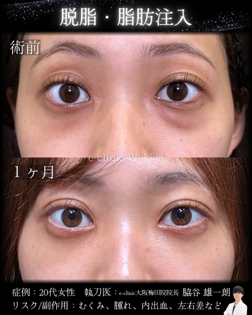 脱脂と脂肪注入の症例写真 (1)