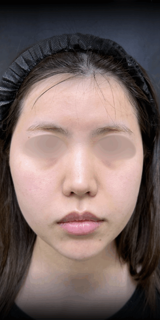 eクリニック大阪梅田院の糸リフトの症例術前写真（名医の脇谷雄一朗医師が執刀）