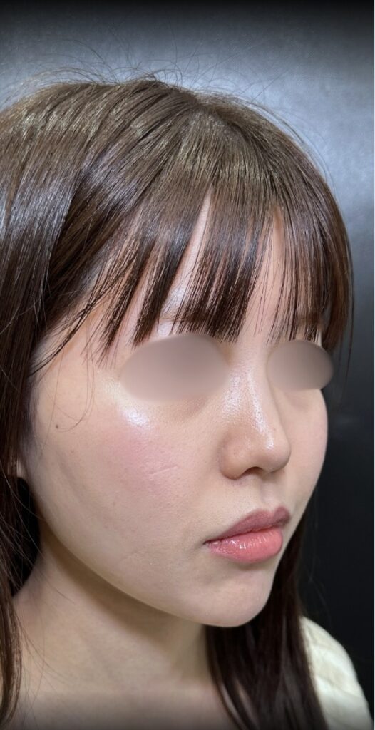 eクリニック大阪梅田院の糸リフトの症例術後写真（名医の脇谷雄一朗医師が執刀）