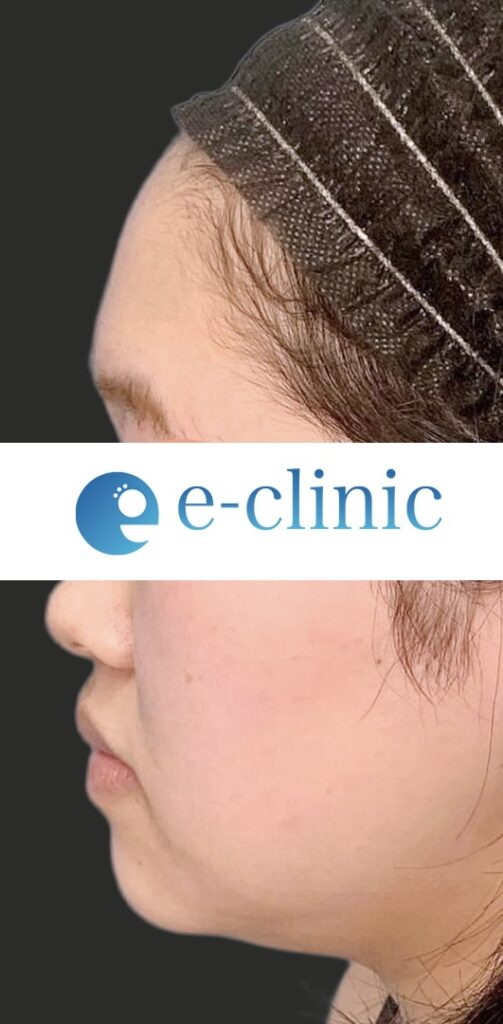 eクリニック大阪梅田院の脂肪注入＋脂肪吸引＋鼻フル＋目尻切開整形の症例術前写真
・目尻切開
・目尻靭帯再配置
・下眼瞼拡大・下制限（タレ目形成）皮膚＋結膜
・眉下切開
・鼻プロテーゼ
・鼻尖形成３D法
・鼻尖部軟骨移植または軟骨膜移植
・鼻中隔延長　保存軟骨
・超音波脂肪吸引Ultra-Z １部位（頬・顎下・メーラーファット）
・糸リフト
・脂肪注入 小パーツ（ゴルゴ）
・脂肪注入 大パーツ（額・こめかみ）
・鼻翼基部（法令線）人工真皮（貴族手術）
（名医の円戸望医師が執刀）