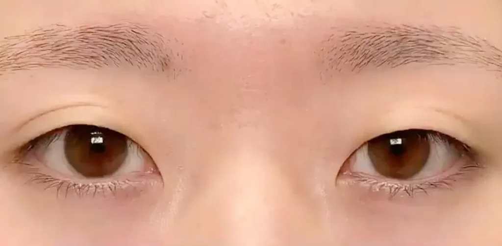 eクリニック大阪梅田院のタレ目形成（グラマラスライン形成）の症例術前写真（名医の円戸望医師が執刀）