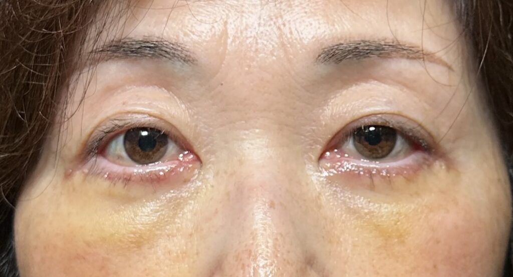 eクリニック大阪梅田院のクマ取り表ハムラ法の症例術後1週間写真(名医の脇谷雄一朗医師が執刀)