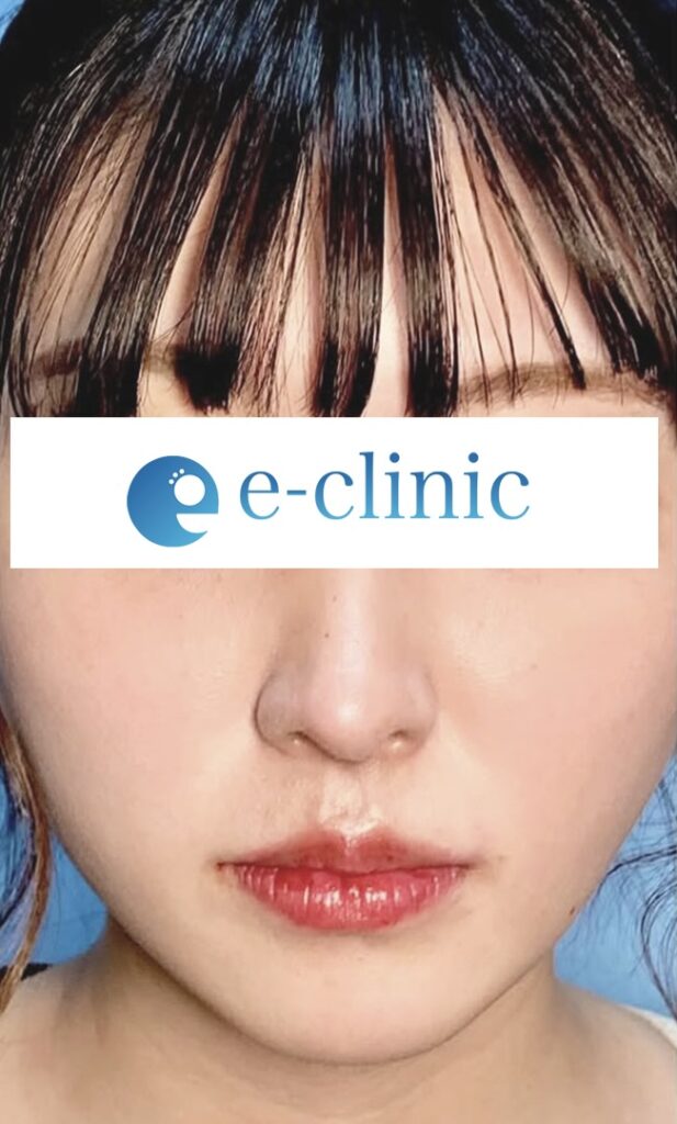 eクリニック大阪梅田院の鼻整形(鼻フル)の症例術後写真(名医の円戸望医師が執刀)
・鼻尖形成3D法
・鼻尖部軟骨移植または軟骨膜移植
・鼻中隔延長 保存軟骨
・超音波脂肪吸引Ultra-Z 顎下