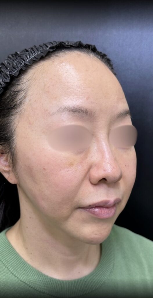 eクリニック大阪梅田院の糸リフトの症例術前写真(名医の脇谷雄一朗医師が執刀)