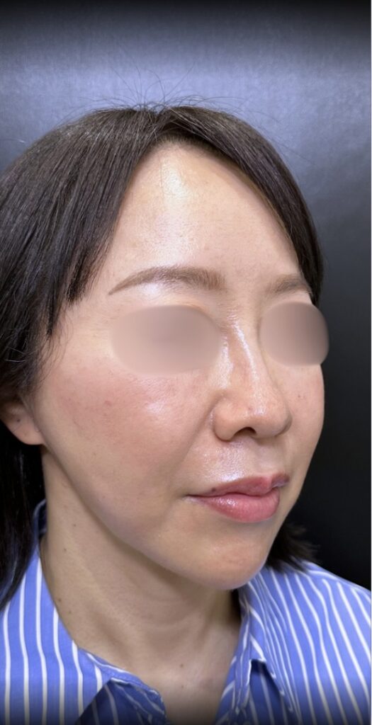 eクリニック大阪梅田院の糸リフトの症例術後写真(名医の脇谷雄一朗医師が執刀)