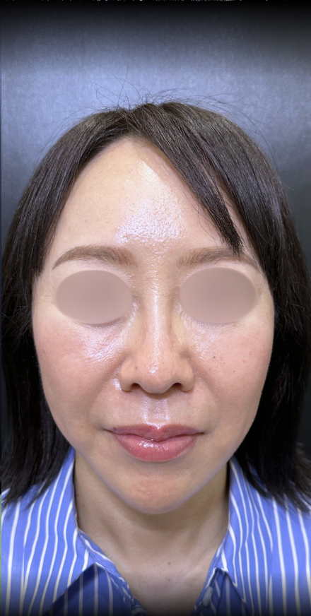 eクリニック大阪梅田院の糸リフトの症例術後写真(名医の脇谷雄一朗医師が執刀)