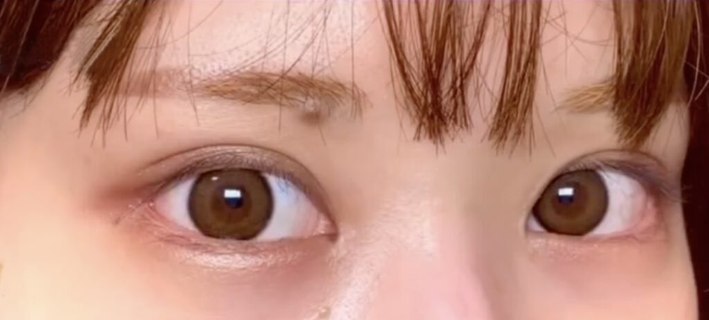 eクリニック大阪梅田院のタレ目形成（グラマラスライン形成）の症例術後写真（名医の円戸望医師が執刀）