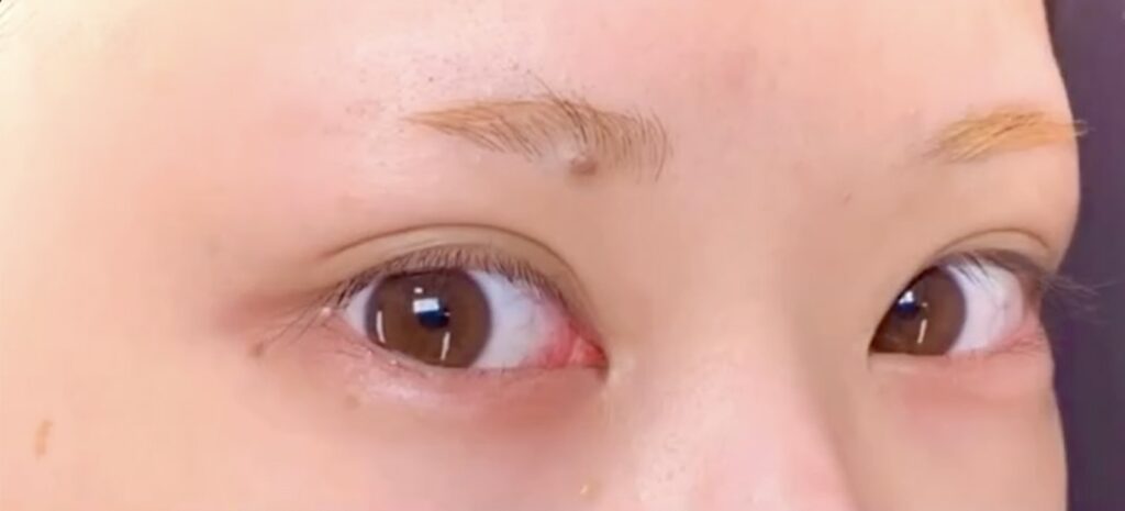 eクリニック大阪梅田院のタレ目形成（グラマラスライン形成）の症例術前写真（名医の円戸望医師が執刀）