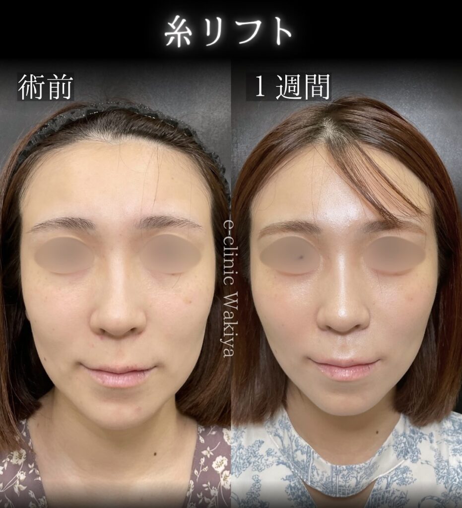 eクリニック大阪梅田院の糸リフトの症例写真（名医の脇谷雄一朗医師が執刀）