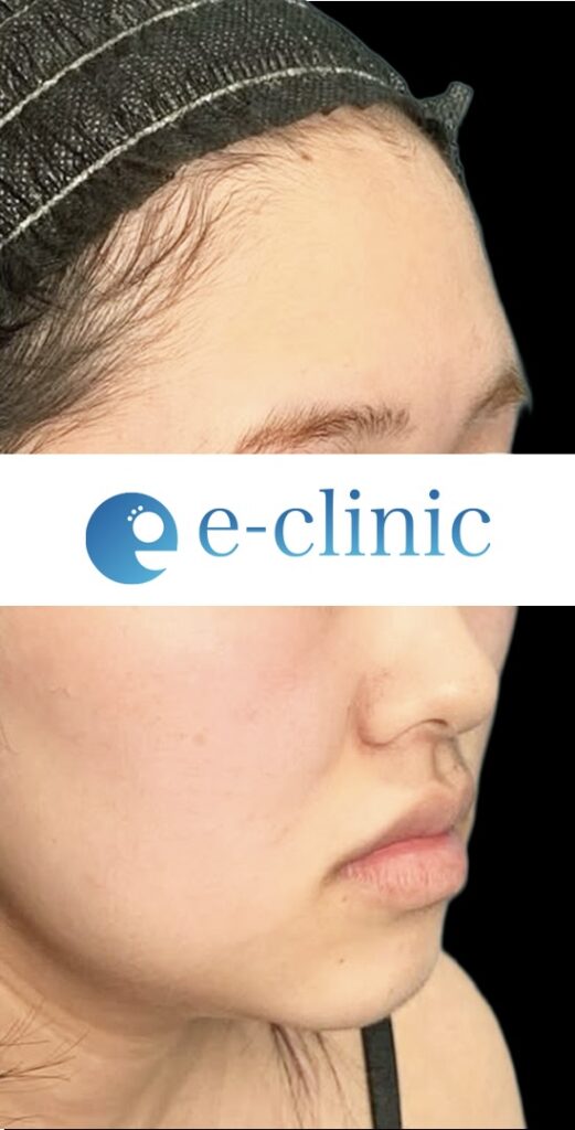 eクリニック大阪梅田院の脂肪注入＋脂肪吸引＋鼻フル＋目尻切開整形の症例術前写真
・目尻切開
・目尻靭帯再配置
・下眼瞼拡大・下制限（タレ目形成）皮膚＋結膜
・眉下切開
・鼻プロテーゼ
・鼻尖形成３D法
・鼻尖部軟骨移植または軟骨膜移植
・鼻中隔延長　保存軟骨
・超音波脂肪吸引Ultra-Z １部位（頬・顎下・メーラーファット）
・糸リフト
・脂肪注入 小パーツ（ゴルゴ）
・脂肪注入 大パーツ（額・こめかみ）
・鼻翼基部（法令線）人工真皮（貴族手術）
（名医の円戸望医師が執刀）