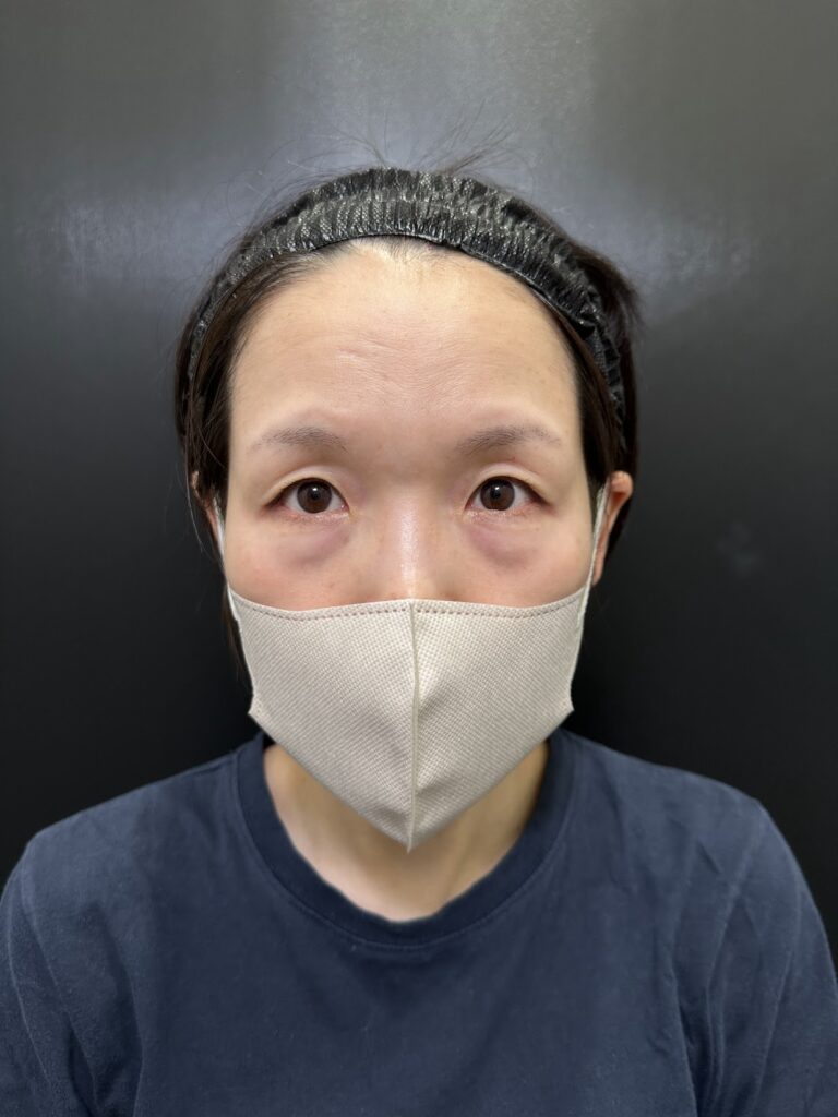 eクリニック大阪梅田院の裏ハムラ法の症例写真（名医の脇谷雄一朗医師が執刀）