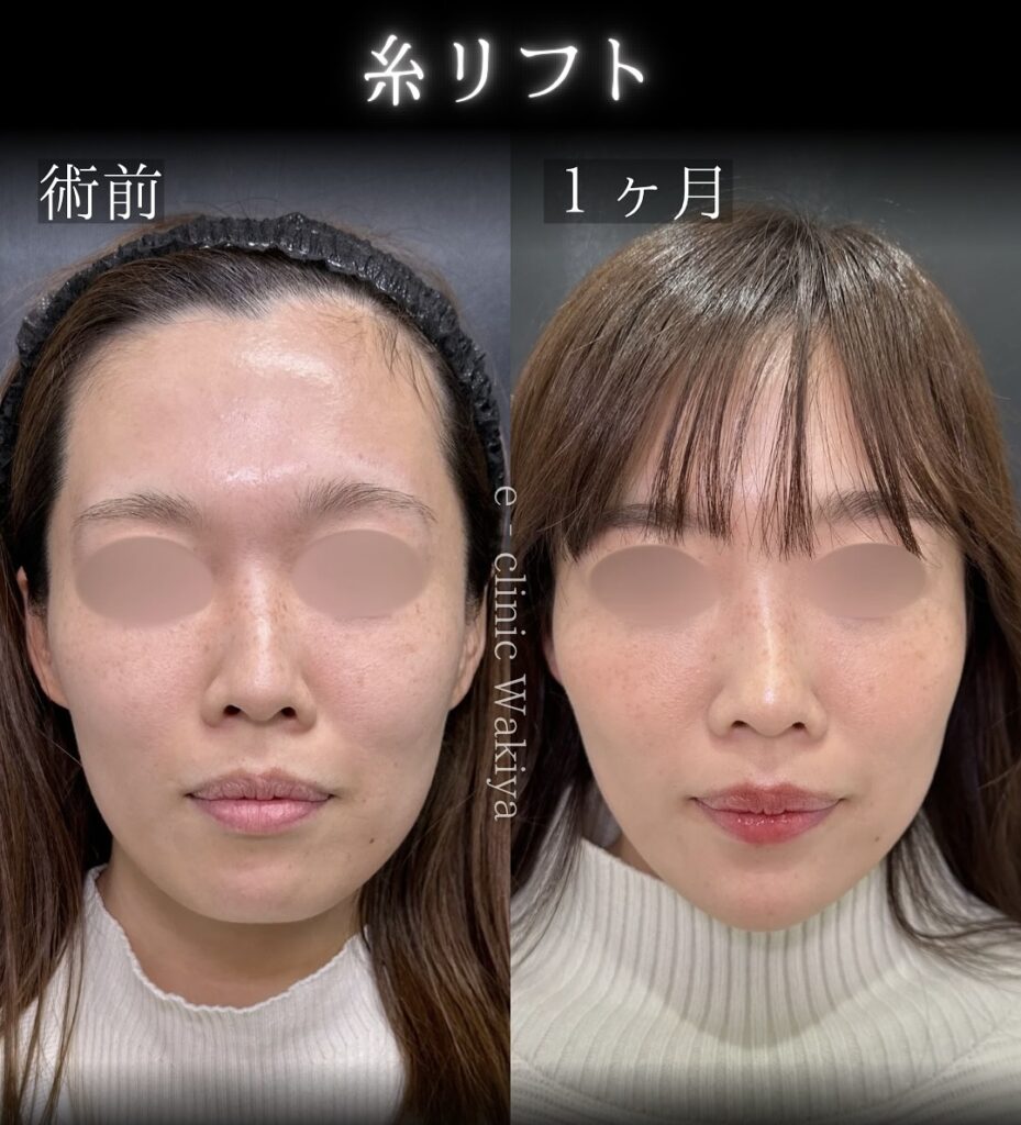 eクリニック大阪梅田院の糸リフトの症例写真（名医の脇谷雄一朗医師が執刀）