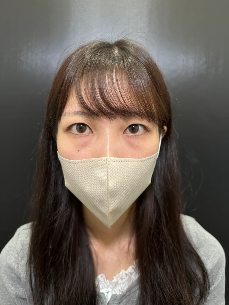 eクリニック大阪梅田院の裏ハムラ法の術前症例写真
（名医の脇谷雄一朗医師が執刀）