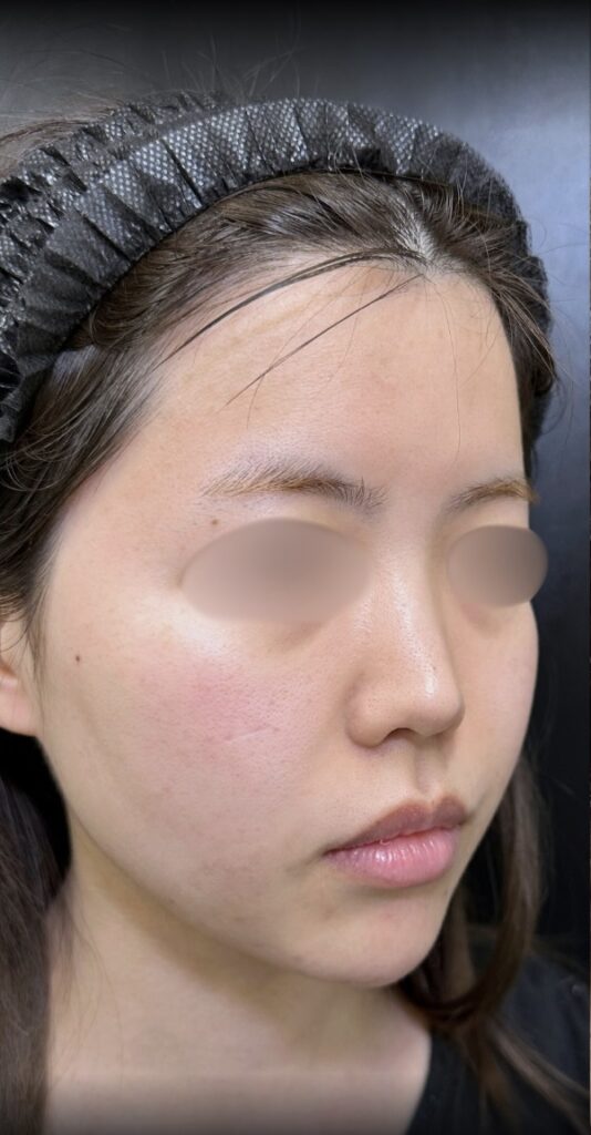 eクリニック大阪梅田院の糸リフトの症例術前写真（名医の脇谷雄一朗医師が執刀）